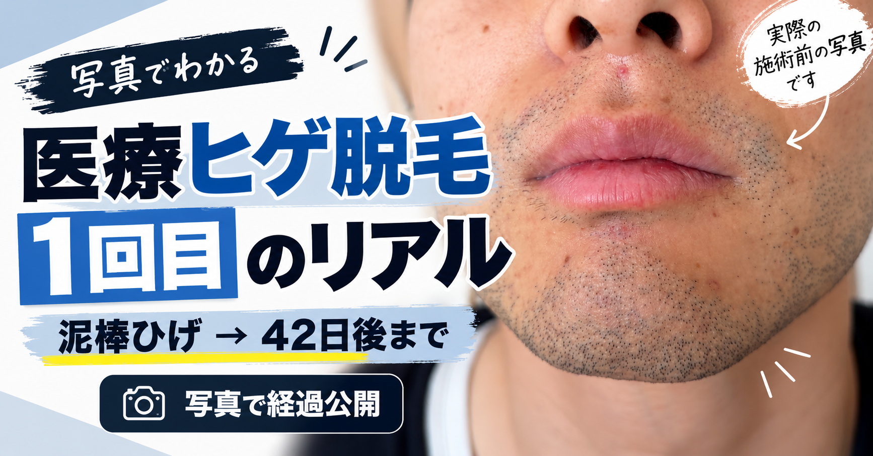 医療ヒゲ脱毛1回目の効果は？泥棒ひげの経過を写真でリアルに公開