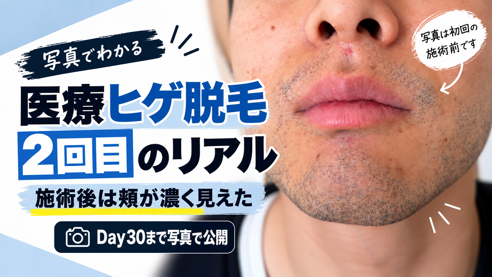 医療ヒゲ脱毛2回目の効果は？濃く見えた経過を写真で公開