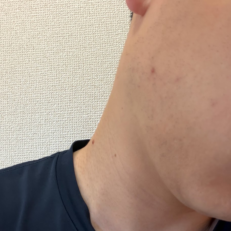 医療ヒゲ脱毛3回目の施術18日後。髭剃り前の右頬とあごの状態。