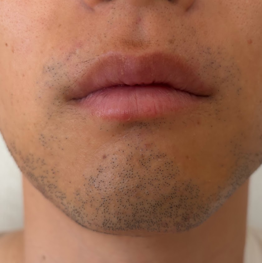 2回目の施術後Day30、ヒゲ剃り前の正面