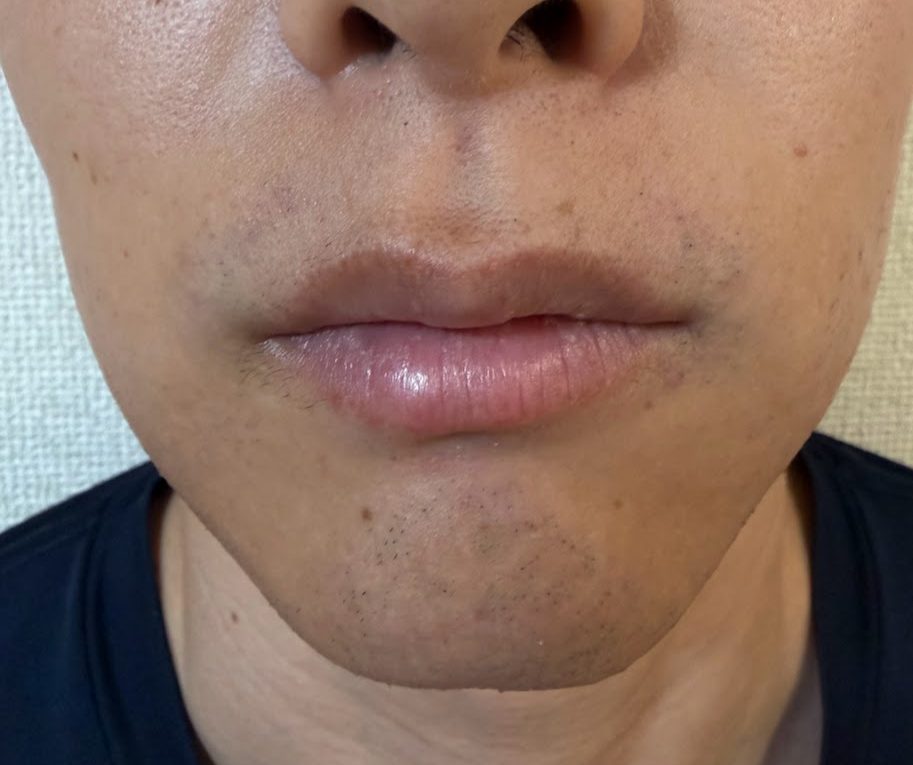 医療ヒゲ脱毛3回目から14日後。髭剃り前の口周りとあごを正面から撮影。