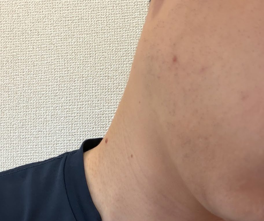 医療ヒゲ脱毛3回目から18日後。髭剃り前の右頬とあごの状態。