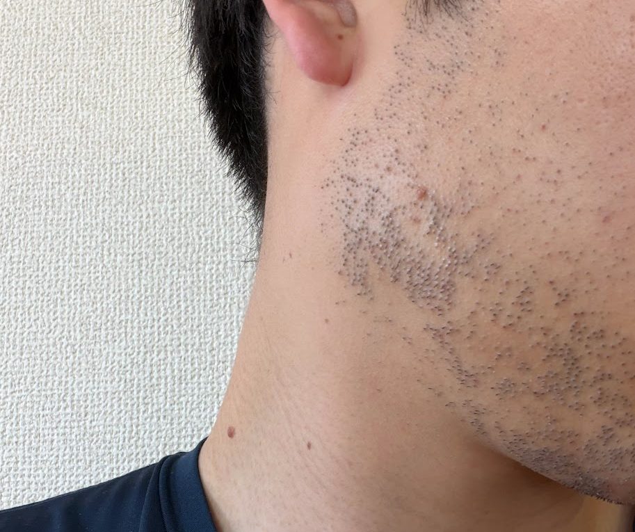 医療ヒゲ脱毛3回目から4日後。髭剃り前の右頬とあごの状態。