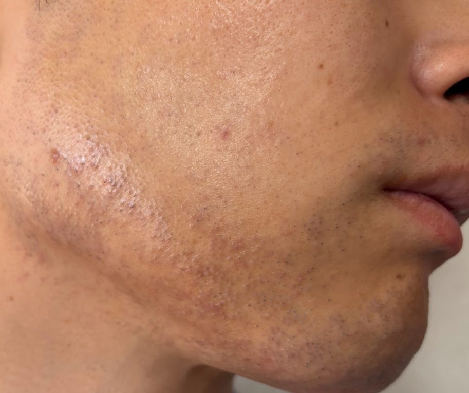 医療ヒゲ脱毛3回目の施術後。右頬